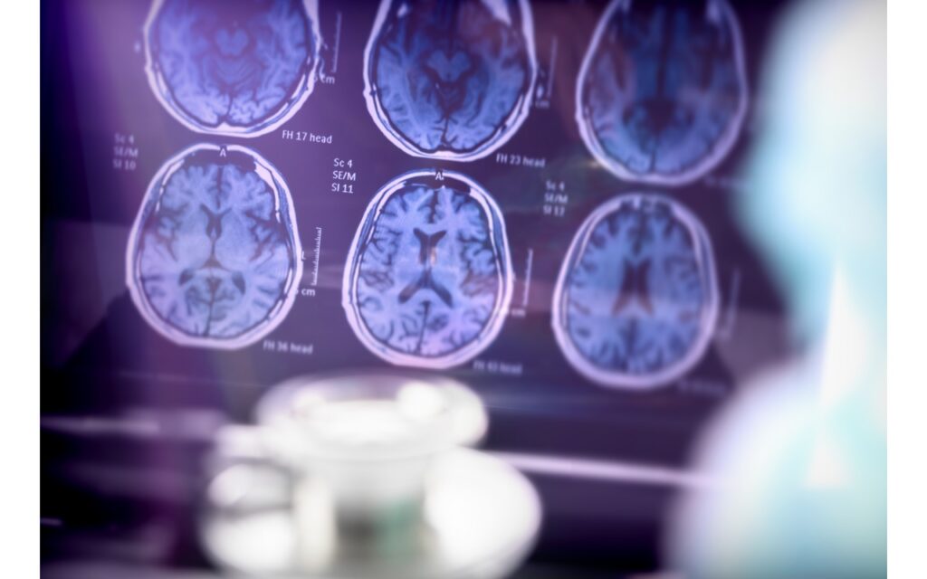 Foshou San: A Potential Approach to Alzheimer's Disease and Endometriosis