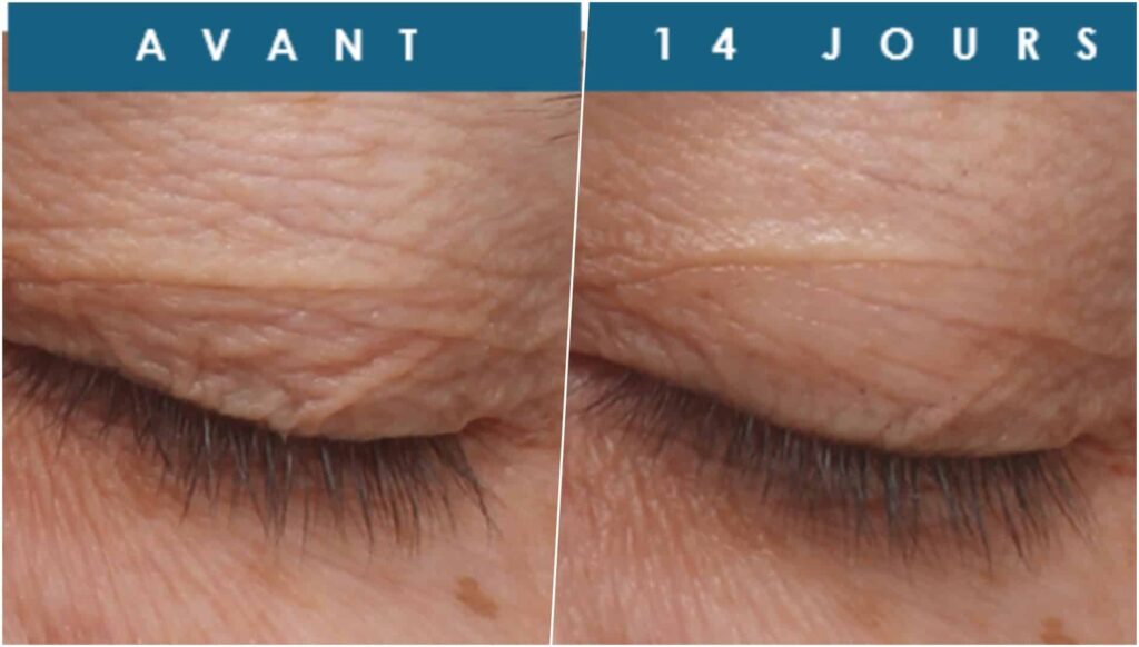 Anti-Wrinkle Serum Lifts Eyelids in 2 Weeks