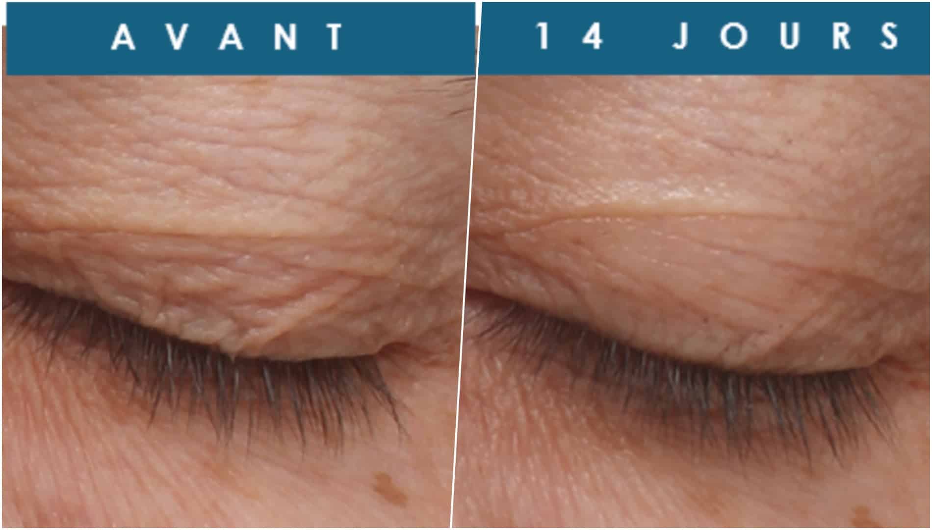 Anti-Wrinkle Serum Lifts Eyelids in 2 Weeks