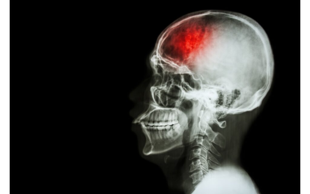 Copper May Protect Brain Health After a Stroke