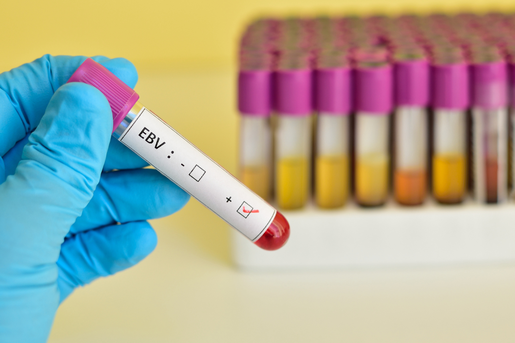 EBV: Human Monoclonal Antibodies That Block Entry into B Cells